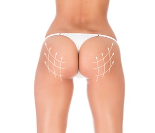 What to Expect Before and After Buttock Augmentation