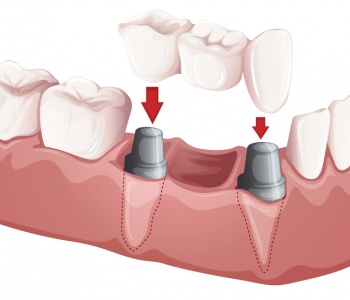 Dental Bridges vs Implants