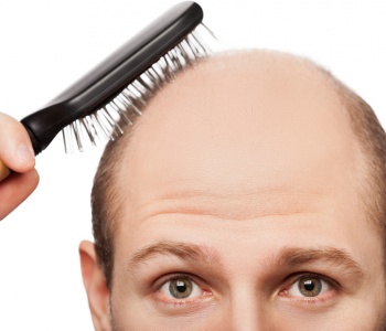 Causes of Hairloss